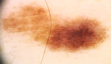 Image dermatoscopique
