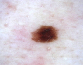 Naevus atypiques