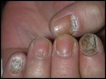 psoriasis ongle