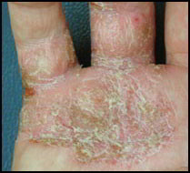 psoriasis palmo plantaire