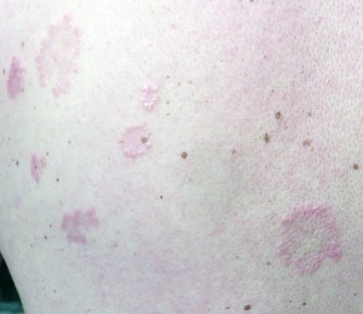 Granulome annulaire multiple