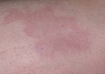 Granulome annulaire forme plane